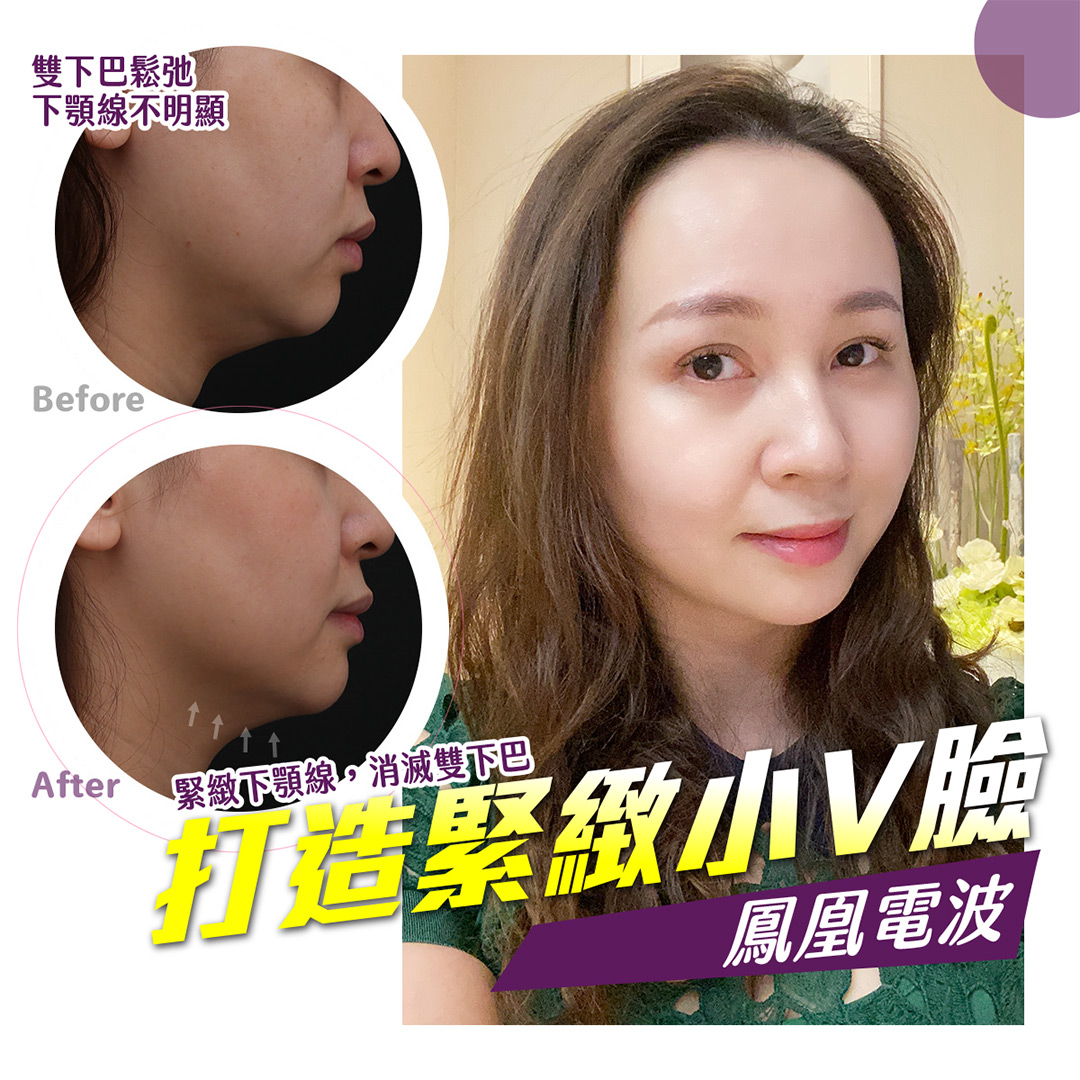 鳳凰電波拉提療程拉提肌膚鬆弛，打造緊緻小V臉