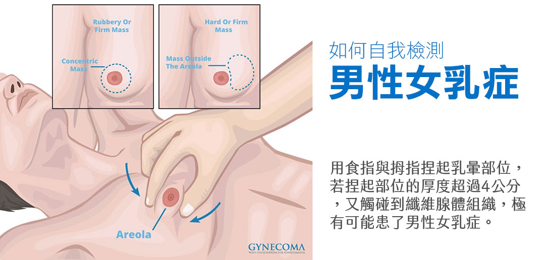 如何自我檢測男性女乳症 如何自我檢測男性女乳症