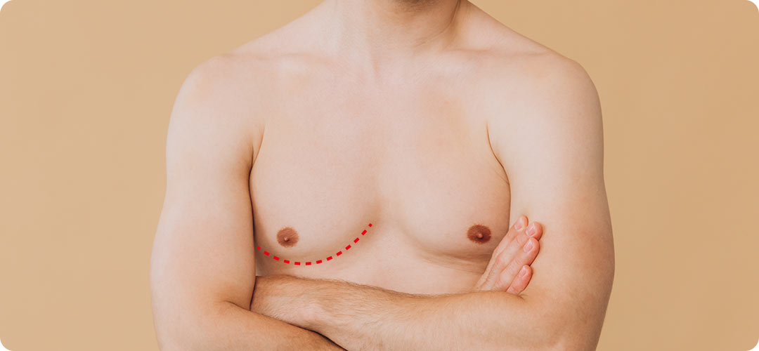 男性女乳症的治療方式|乳房切除