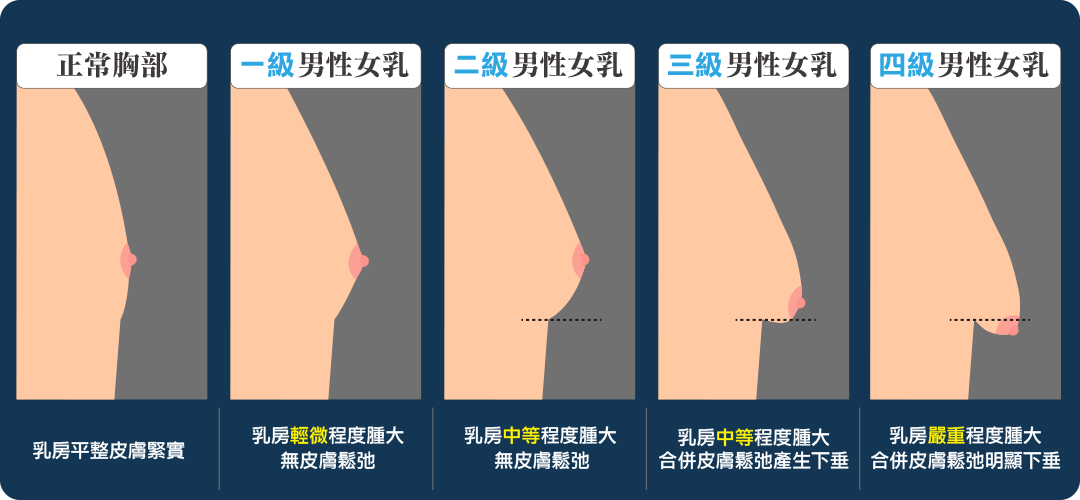 男性女乳症嚴重程度 男性女乳症嚴重程度