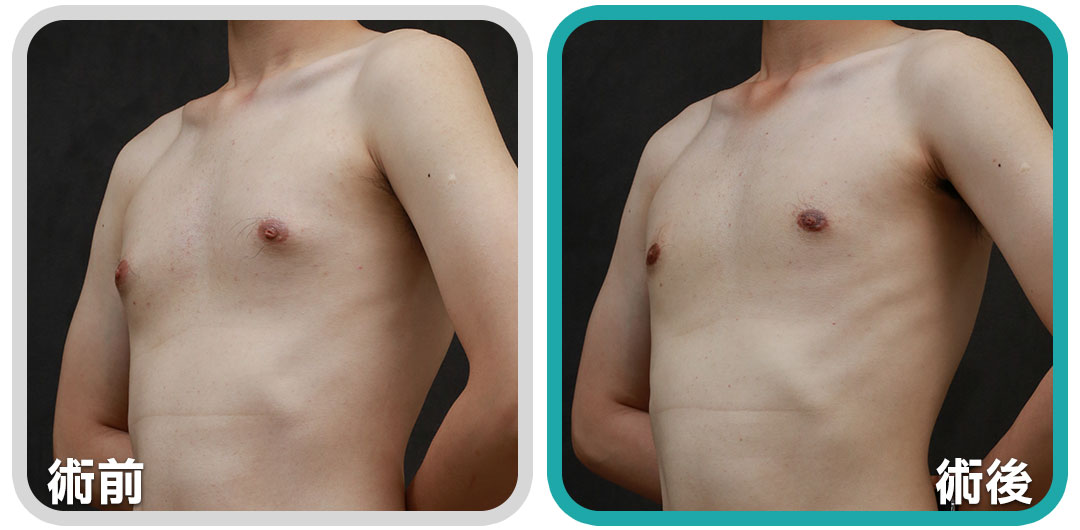 乳腺型男性女乳症案例,經過手術後乳頭激凸問題改善,恢復正常男性胸型 乳腺型男性女乳症案例01,經過手術後乳頭激凸問題改善,恢復正常男性胸型