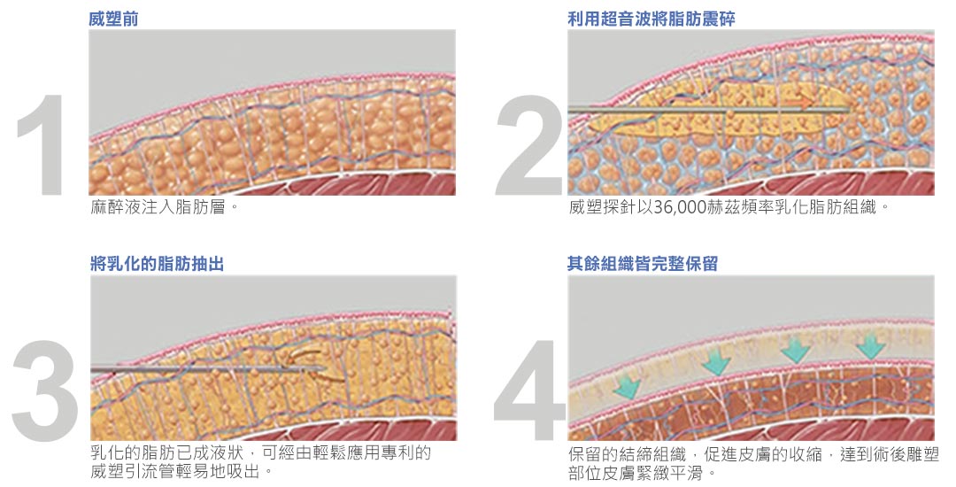 台中抽脂VASER威塑抽脂原理說明圖示-02 台中抽脂VASER威塑抽脂原理說明圖示-02