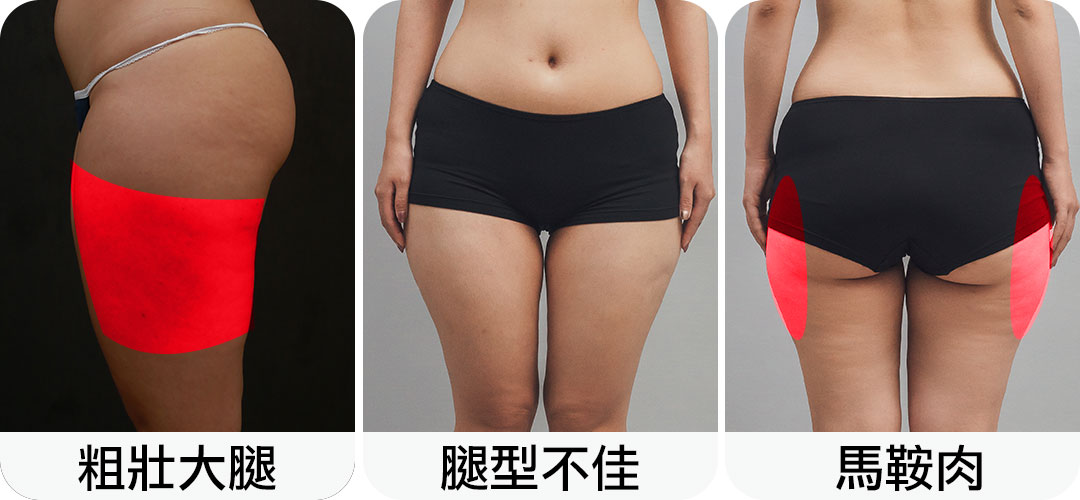 大腿抽脂困擾|粗壯大腿|腿型不佳|馬鞍肉