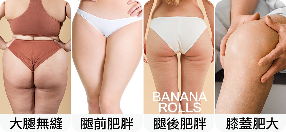 大腿抽脂困擾|大腿無縫|腿前肥胖|腿後肥胖(Banana Rolls)|膝蓋肥大