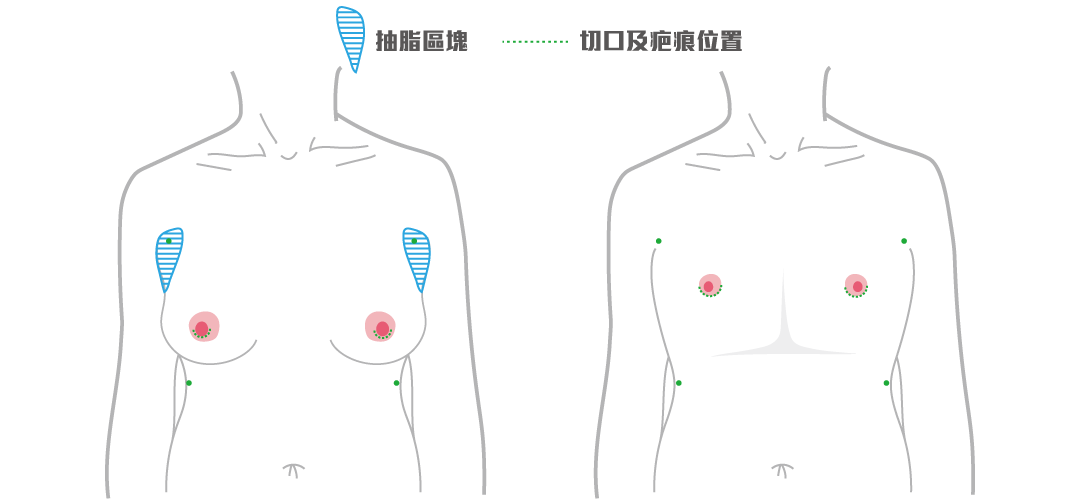 平胸手術方式:乳暈微創平胸手術 平胸手術方式:乳暈微創平胸手術