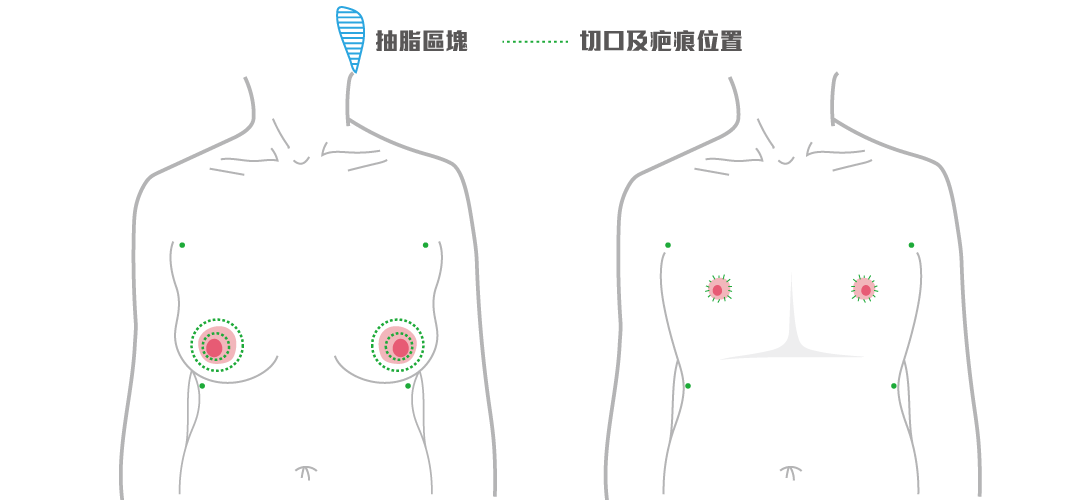 平胸手術方式:乳暈環切平胸手術 平胸手術方式:乳暈環切平胸手術