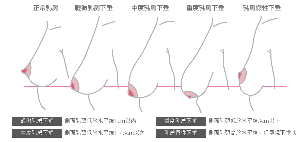 如何判斷是否胸部下垂|判斷胸部下垂的方式