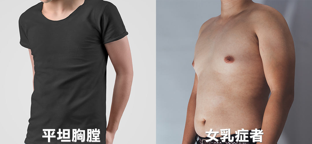 平胸手術目的:平坦胸膛|女乳症患者 平胸手術目的:平坦胸膛|女乳症患者