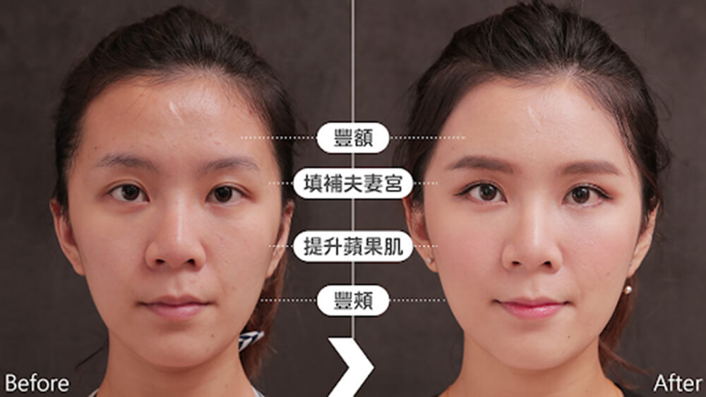 微粹脂手術與傳統抽脂手術比較_1L